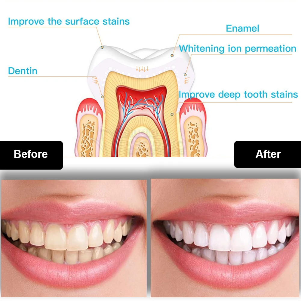 Kit per sbiancamento dei denti - Teeth Whitening At Home recensione e prezzo